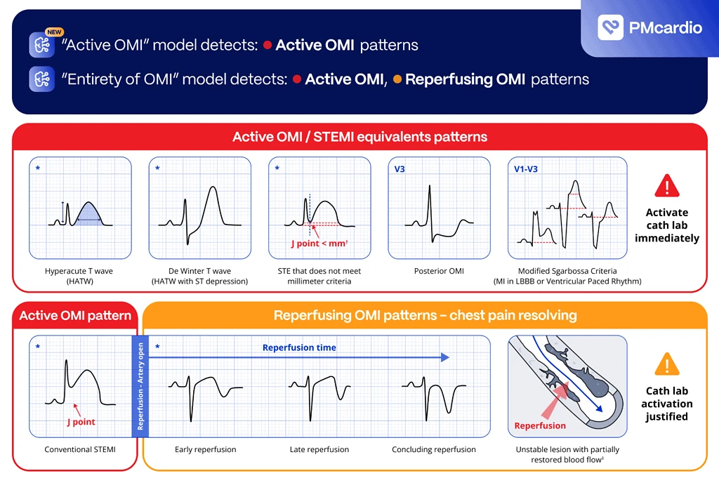 PMcardio OMI AI model diagram of active and reperfusing OMI ECG patterns guiding cath lab activation