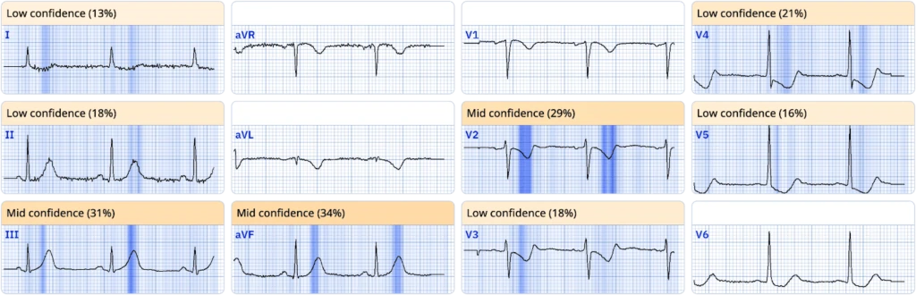 PMcardio AI explainability heat map highlighting diagnostic regions across a 12-lead ECG with confidence scores