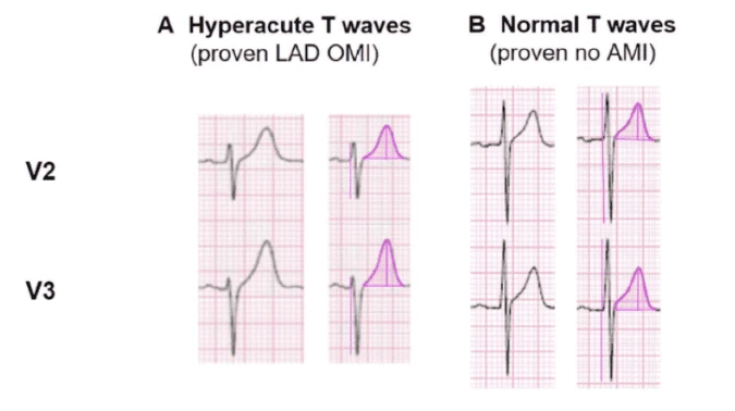 Hyperacute T-waves in leads V2 and V3 of proven LAD OMI compared with normal T-waves