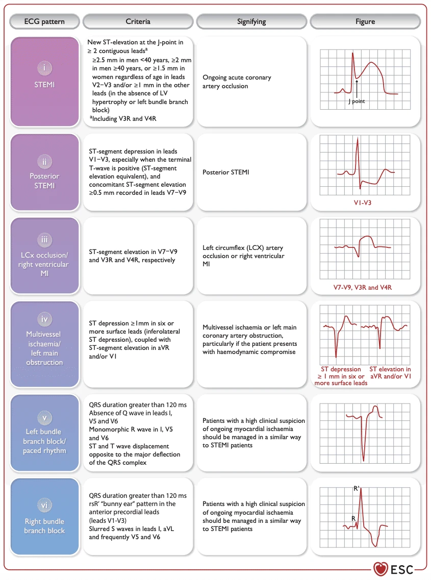 ESC table of STEMI and STEMI-equivalent ECG patterns with diagnostic criteria and example tracings
