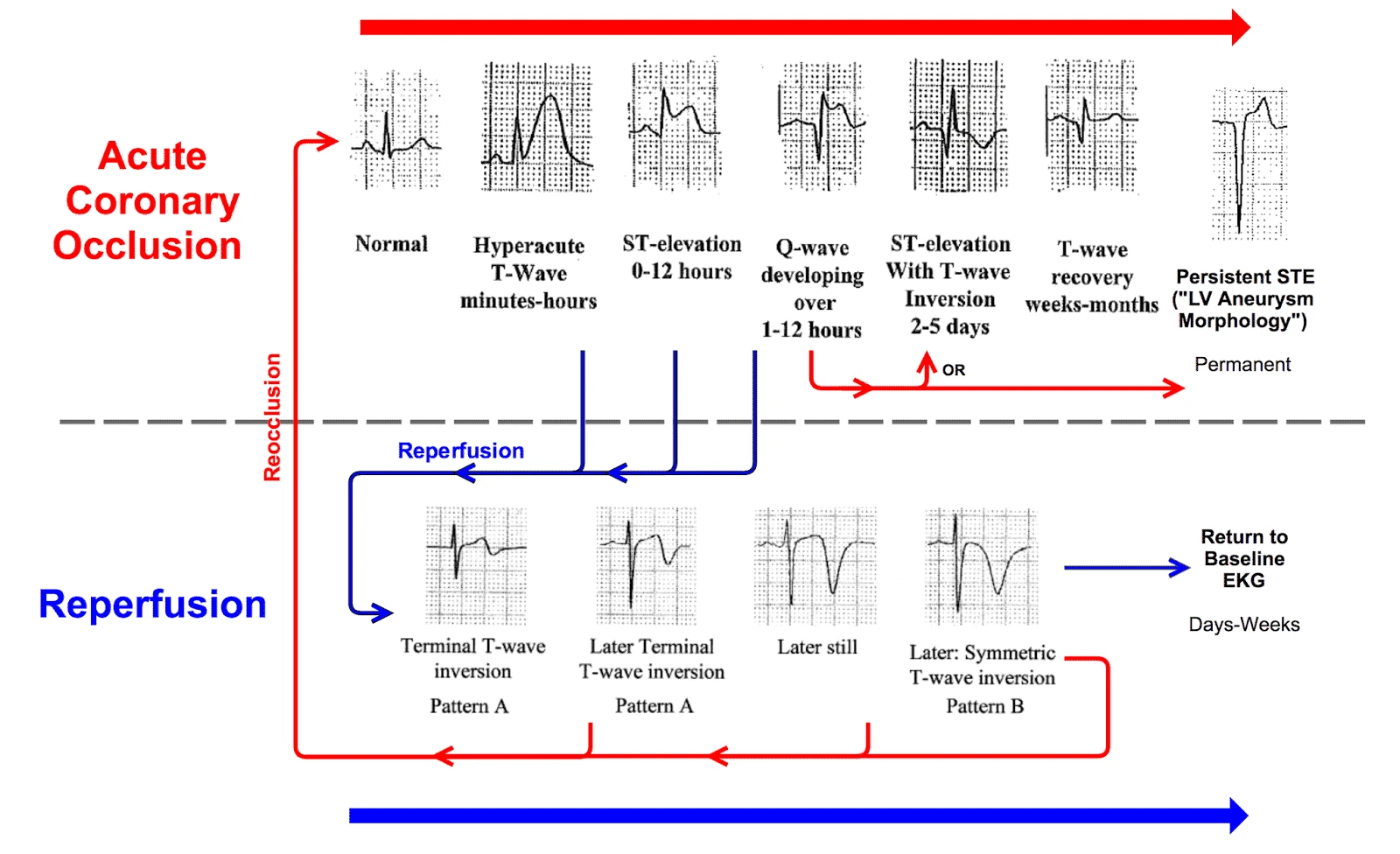 Timeline of dynamic ECG changes across acute coronary occlusion and reperfusion phases