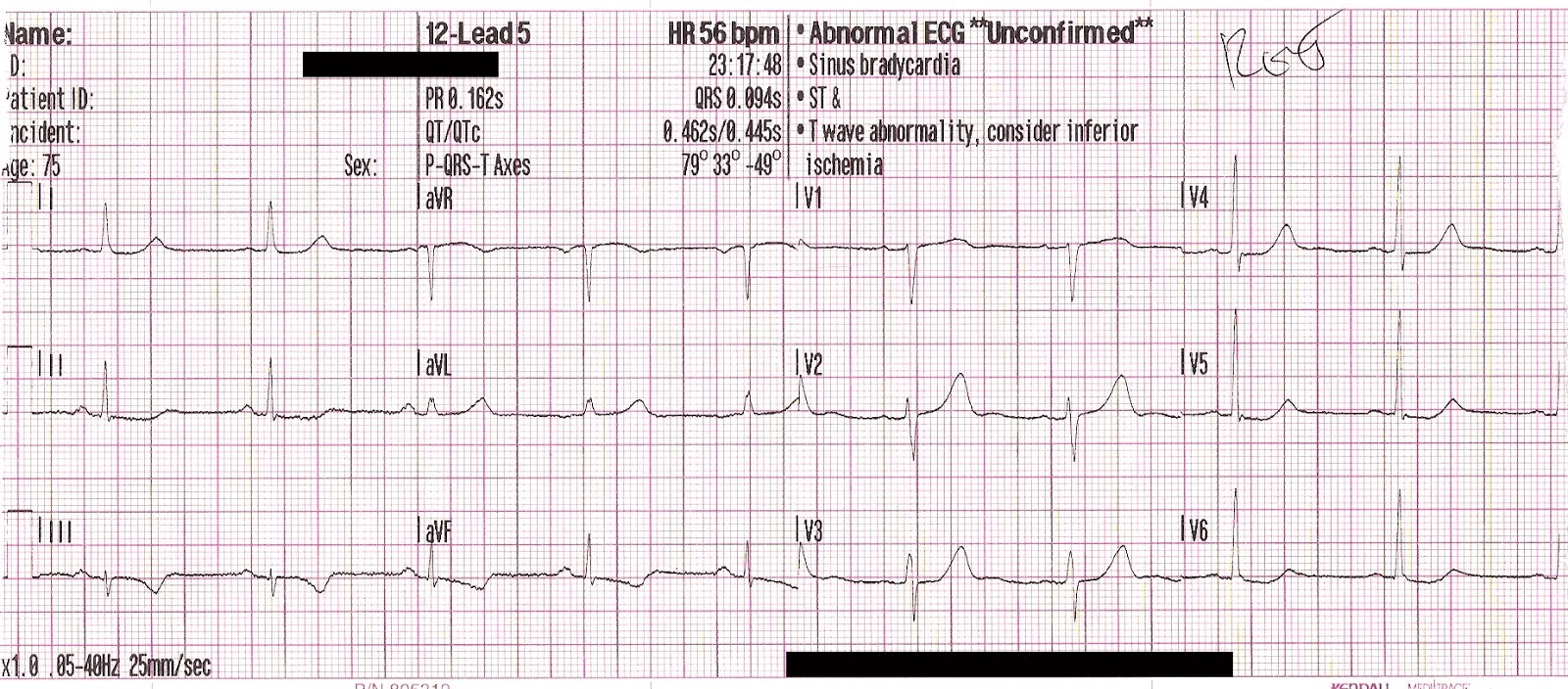 12-lead ECG showing reperfusion T-wave inversions in inferior leads and posterior reperfusion T-waves in V2-V4