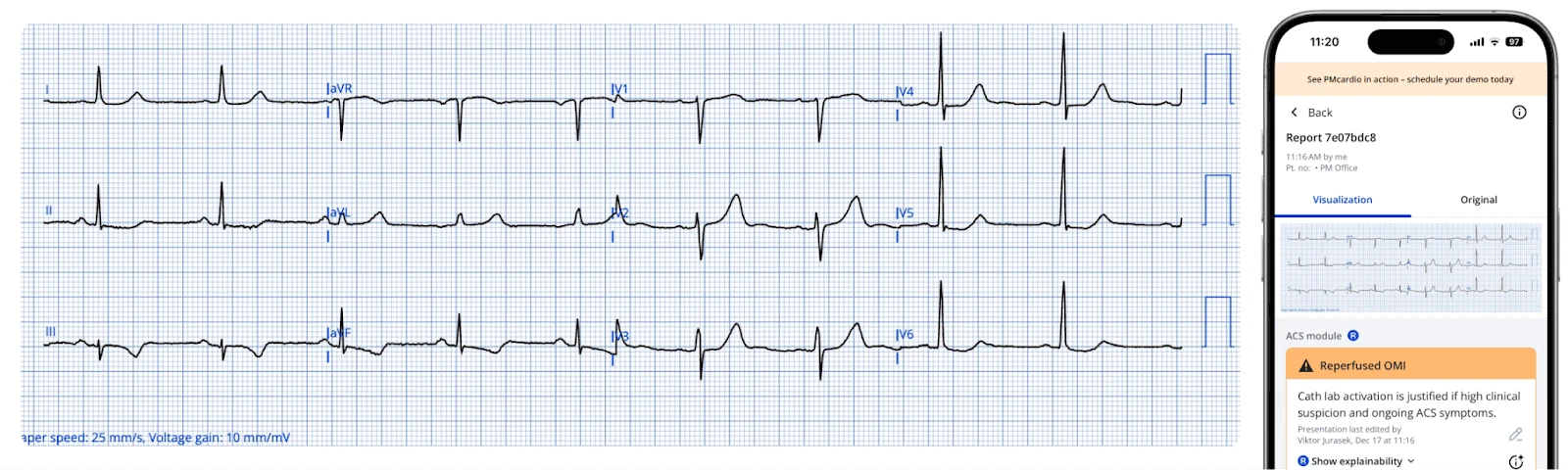 PMcardio digitized ECG and phone report identifying Reperfused OMI with cath lab activation justified