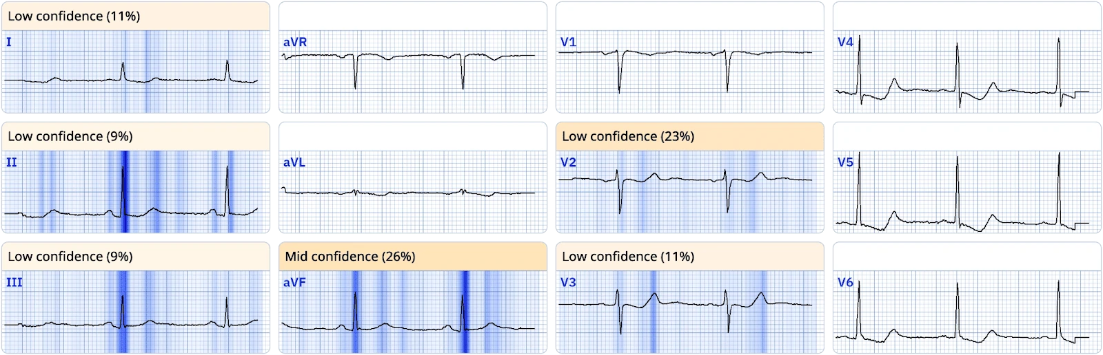 PMcardio explainability heat map of diagnostic leads with reduced confidence on the serial ECG