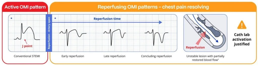 Chart of reperfusing OMI ECG patterns from early to concluding reperfusion versus conventional STEMI