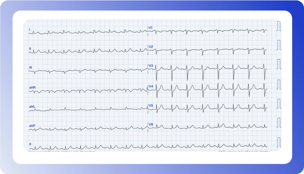 12-lead ECG of a 67-year-old with chest pain showing anterior ST elevation in V3-V4, digitized by PMcardio