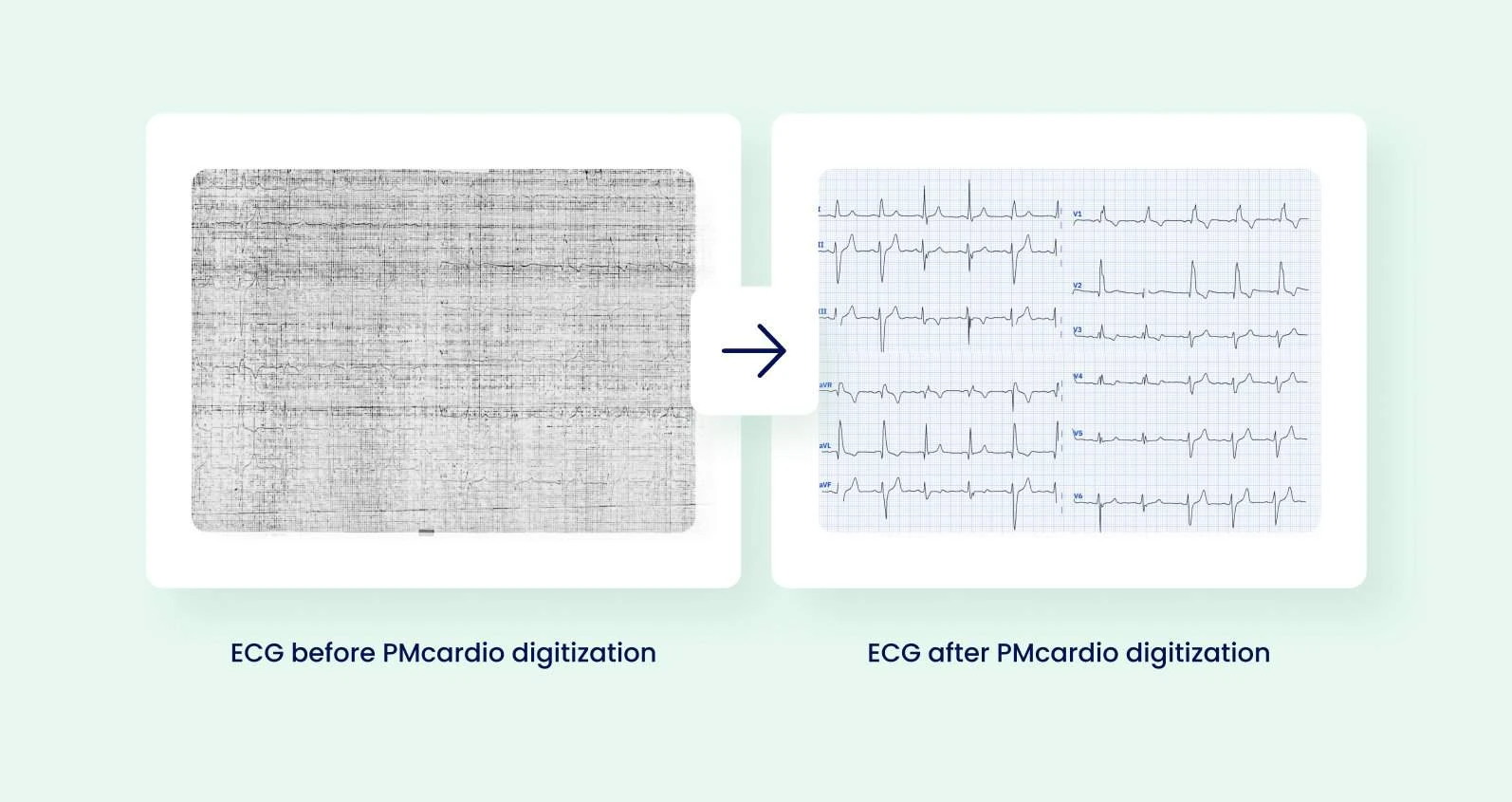 An image of an old, poor-quality ECG tracing compared to straightened out, digitized version of that same ECG tracing digitized by PMcardio