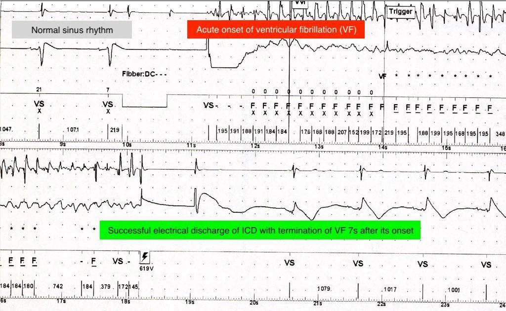 An ECG tracing showing how an implantable cardiac defibrillator (ICD) can successfully terminate a potentially fatal ventricular fibrillation