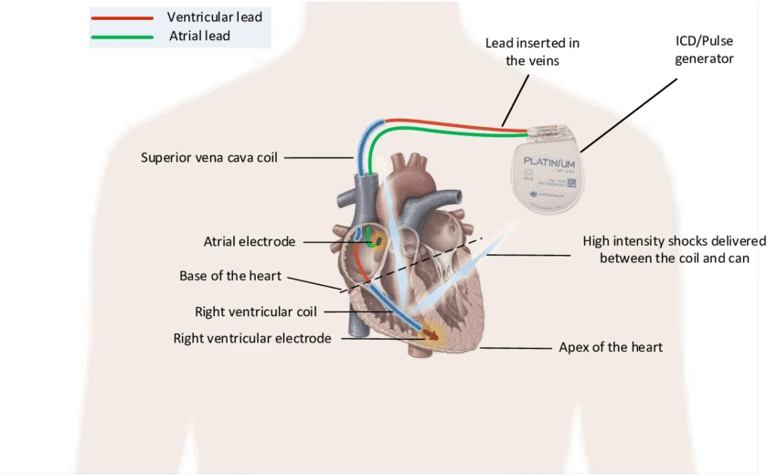 Diagram of an implantable cardioverter defibrillator below the left collarbone with dual-chamber, dual-coil leads into the heart