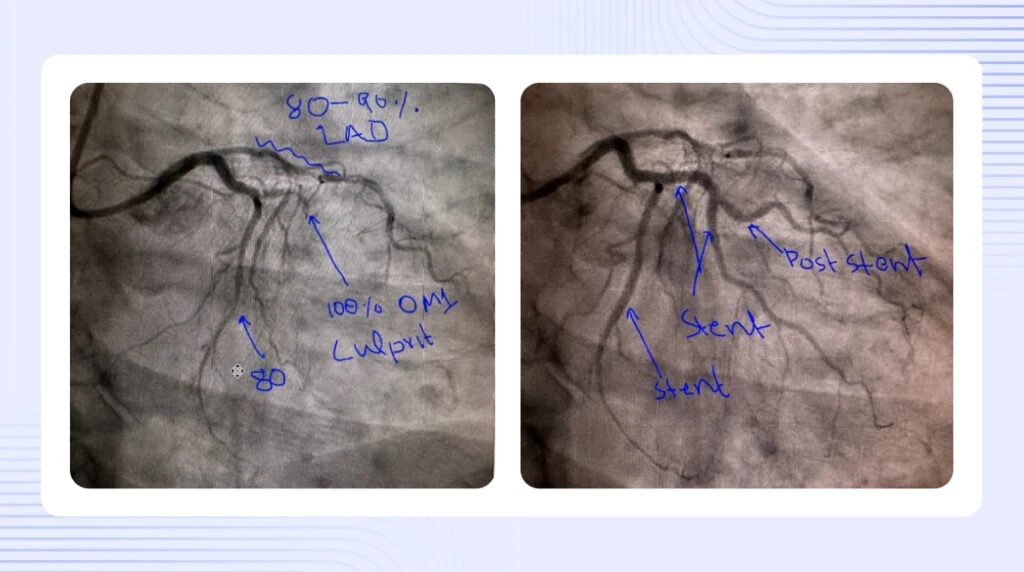 Coronary angiograms with handwritten notes showing 100 percent OMI culprit LAD occlusion before and after stenting