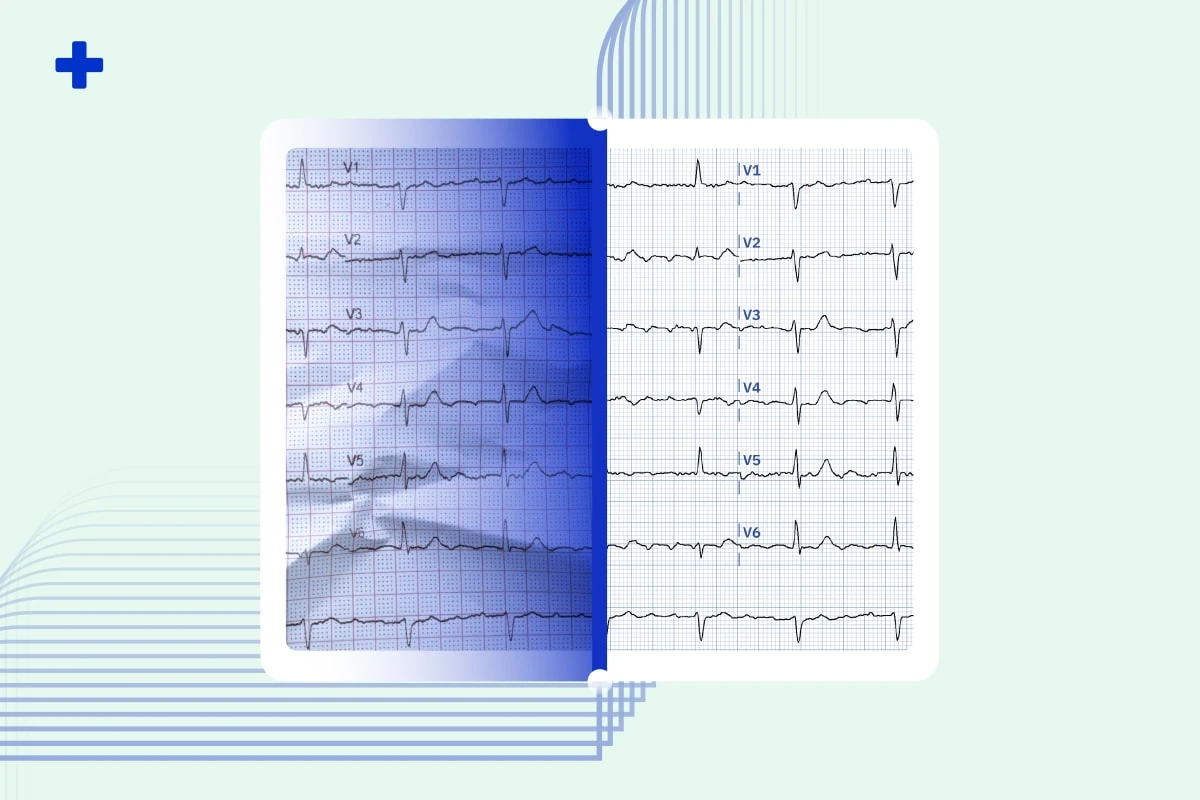Scanned printed ECG reconstructed into a clean digitized 12-lead ECG with leads V1 to V6
