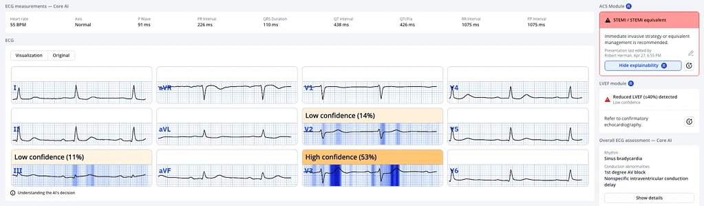 PMcardio Core AI flagging STEMI equivalent with blue explainability heatmaps highlighting leads V2 and V3
