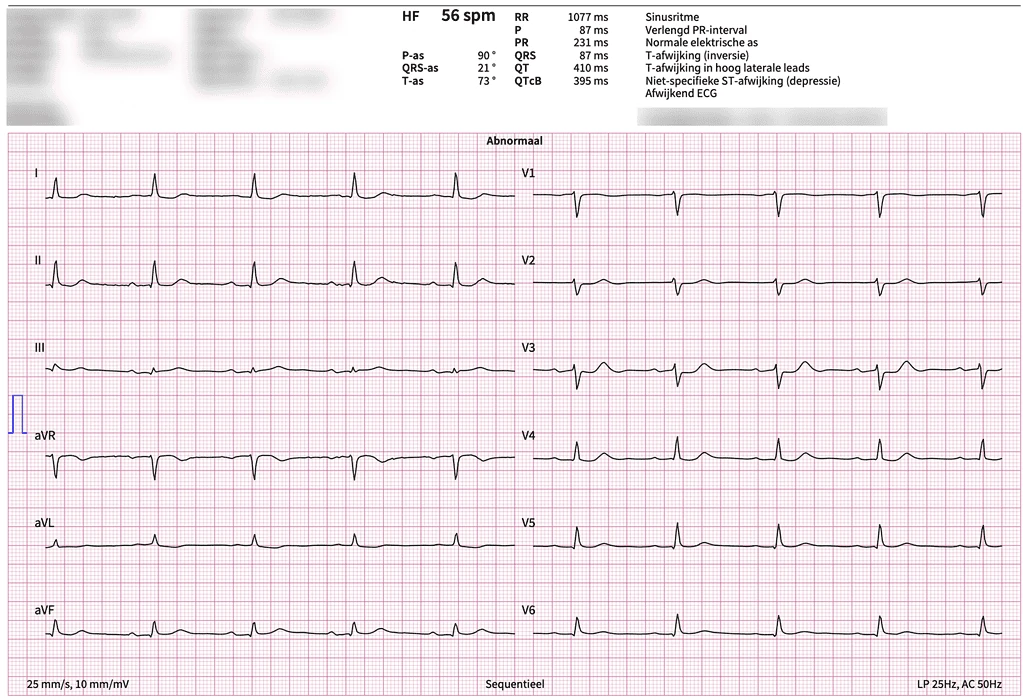 12-lead ECG of infero-posterior STEMI from LCx occlusion misread by conventional algorithm as non-specific abnormal ECG