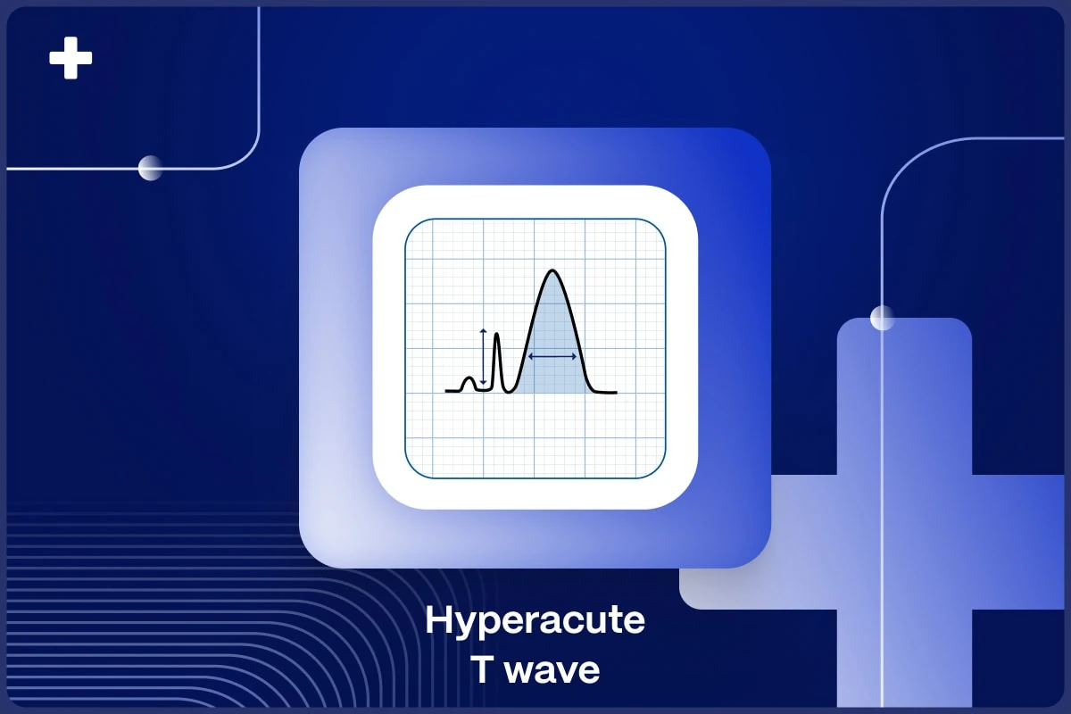Diagram of a hyperacute T-wave, enlarged and symmetric relative to the QRS complex, on ECG grid paper