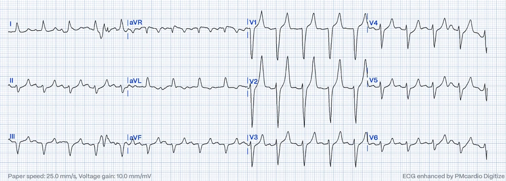 12-lead ECG with pointed tented T-waves, flat ST segment and prolonged QRS of hyperkalemia