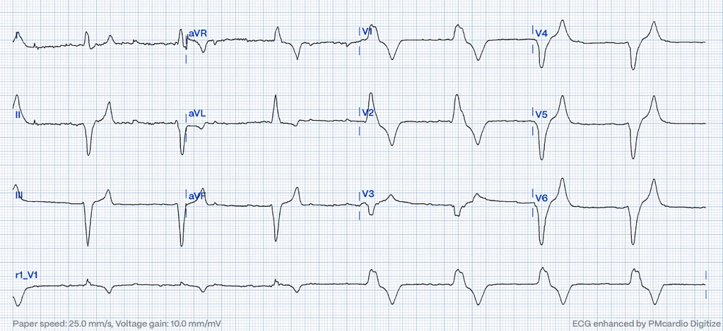 12-lead ECG showing tall peaked T-waves of hyperkalemia