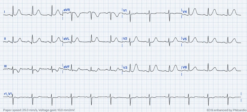 12-lead ECG with large symmetric T-waves in I, aVL and V2-V5 diagnostic of proximal LAD occlusion