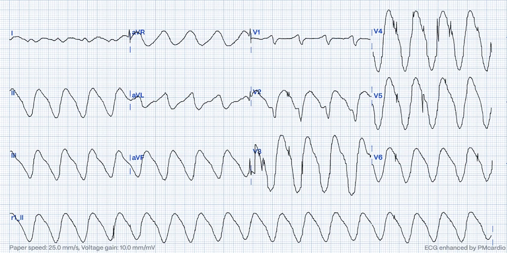 ECG diagnostic of hyperkalemia - severe stages of hyperkalemia