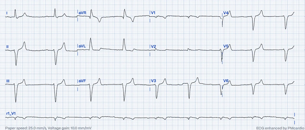 Hyperkalemia - ECG changes