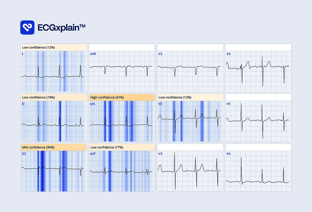 ECGxplain 12-lead ECG heatmap highlighting aVL with high-confidence overlays showing which leads drove PMcardio's AI diagnosis
