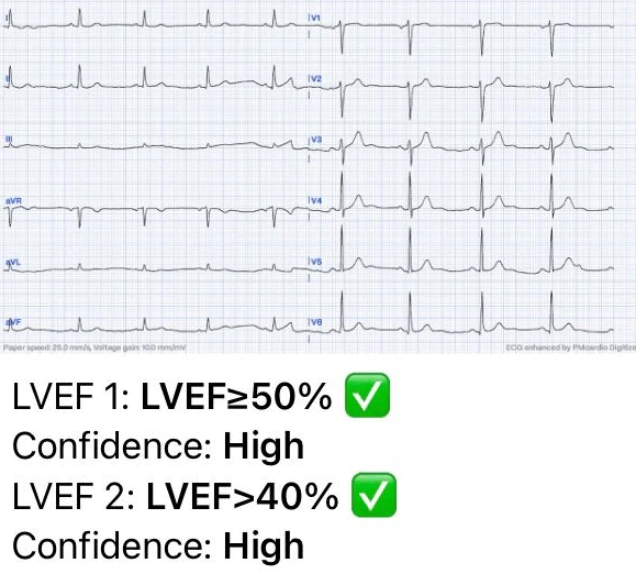 Left Ventricular Systolic Dysfunction ECG Case 3 Normal Left Ventricular Function LVSD AI ECG Interpretation
