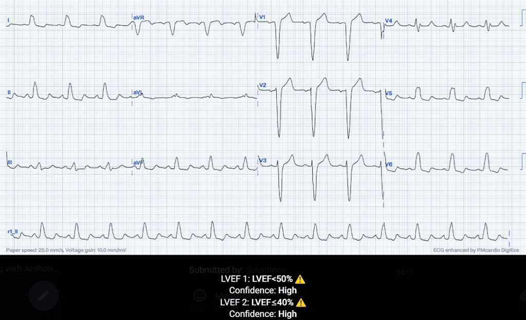 Left Ventricular Systolic Dysfunction ECG Case 4