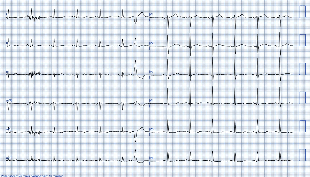 Left Ventricular Systolic Dysfunction graph ECG case 1 Asymptomatic LVSD