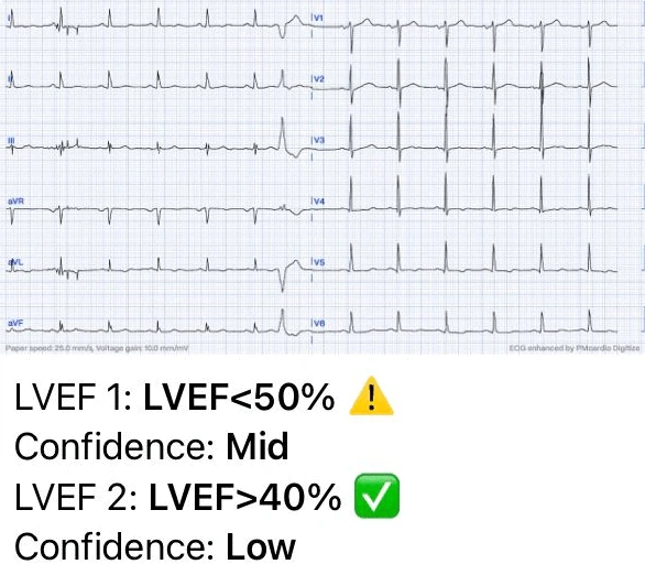Left Ventricular Systolic Dysfunction graph ECG case 1 AI analysis Asymptomatic LVSD