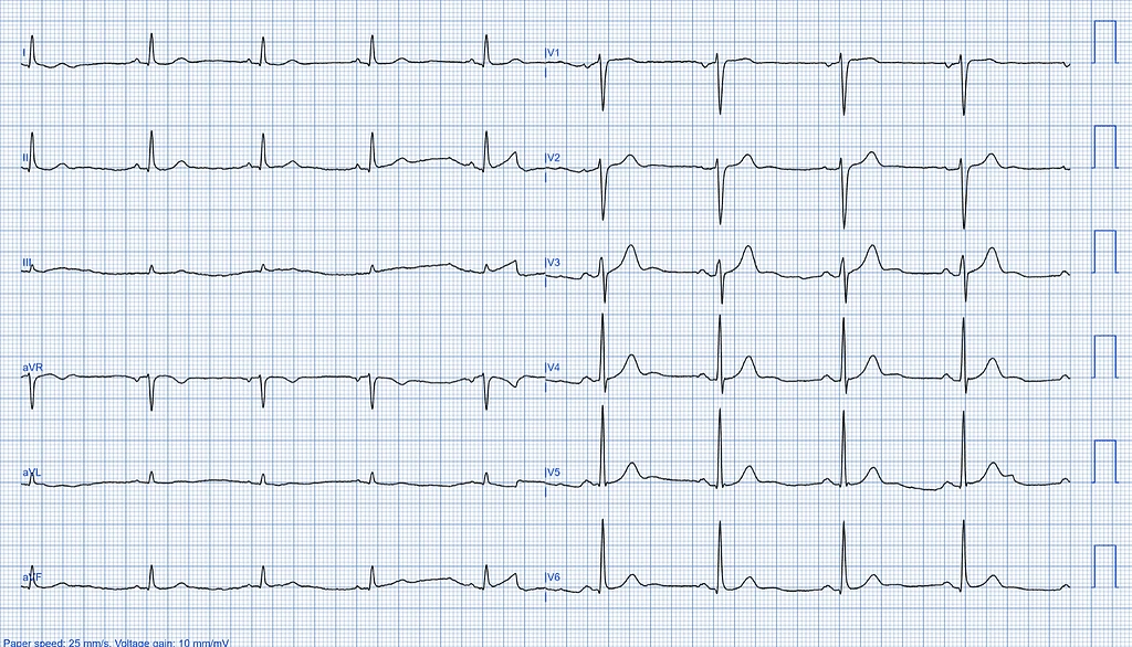Left Ventricular Systolic Dysfunction ECG Case 3 Normal Left Ventricular Function LVSD