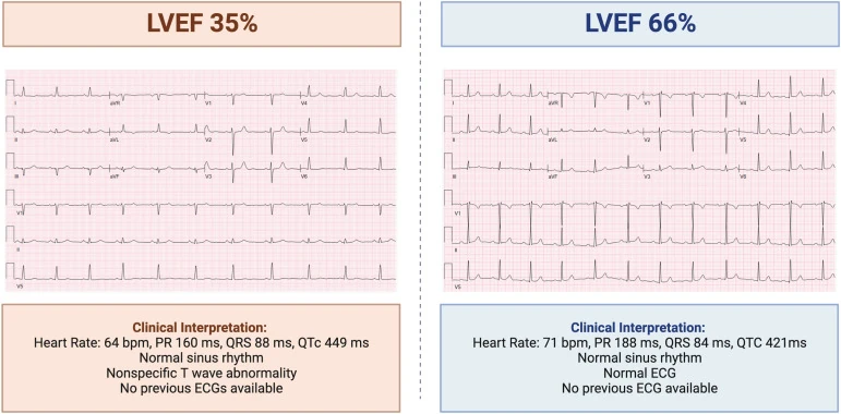 Left Ventricular Systolic Dysfunction graph