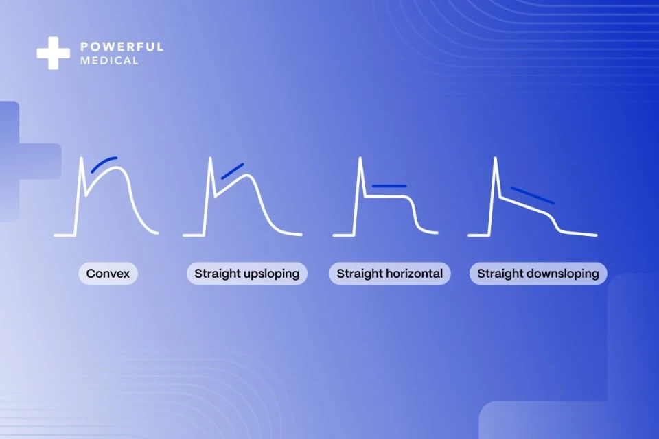 Powerful Medical cover illustrating convex, upsloping, horizontal and downsloping ischemic ST-elevations