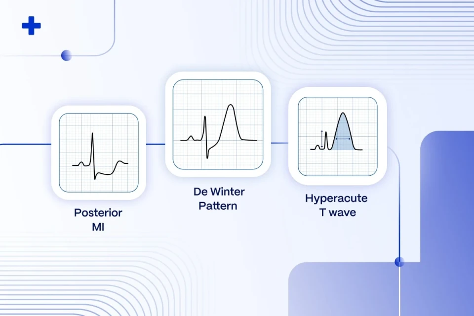 Illustration of three STEMI equivalent ECG patterns posterior MI, De Winter pattern and hyperacute T wave