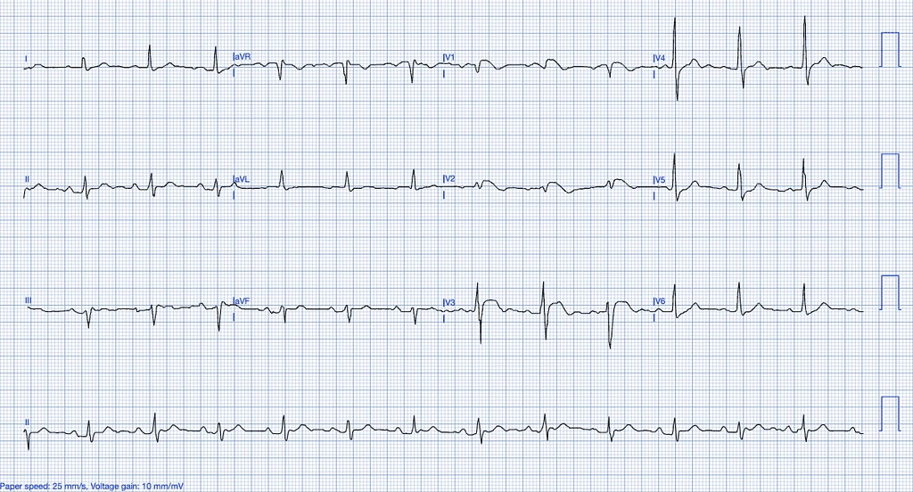 STEMI Mimics Brugada Syndrome ECG Features