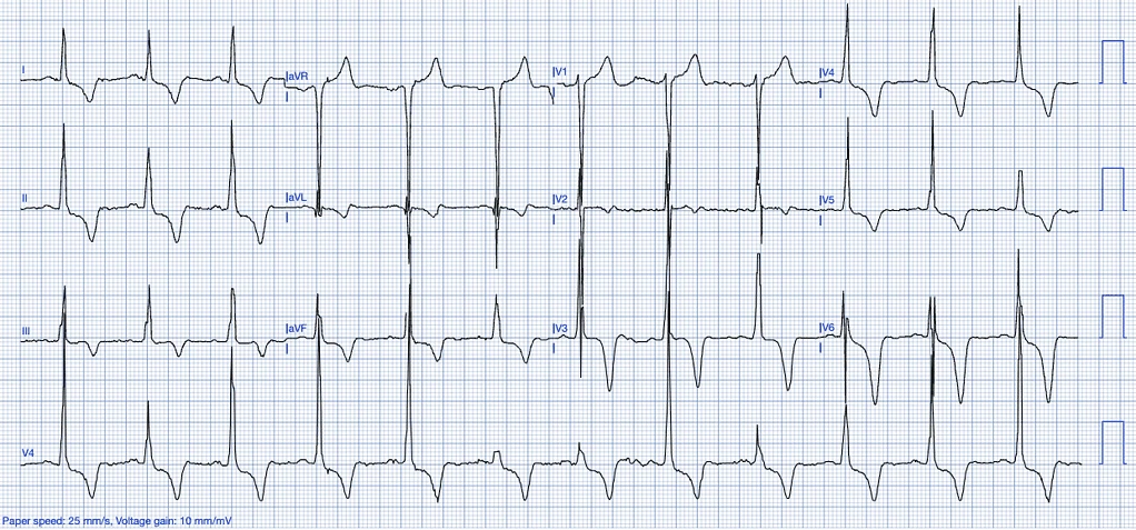 Stemi Mimics ECG Left Ventricular Hypertrophy