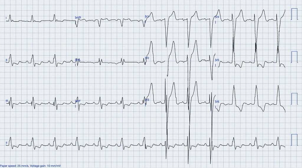 STEMI Mimics ECG Features of Previously Diagnosed LBBB ECG