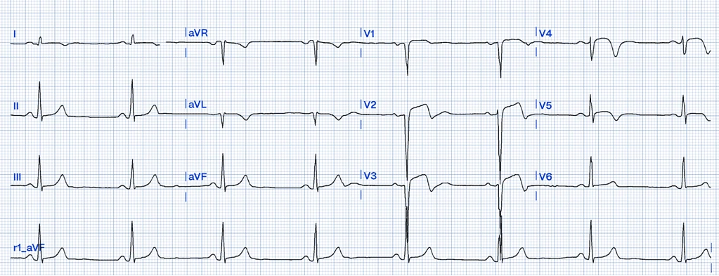 12-lead ECG with precordial ST elevation and QS waves in V2-V3 from left ventricular aneurysm morphology