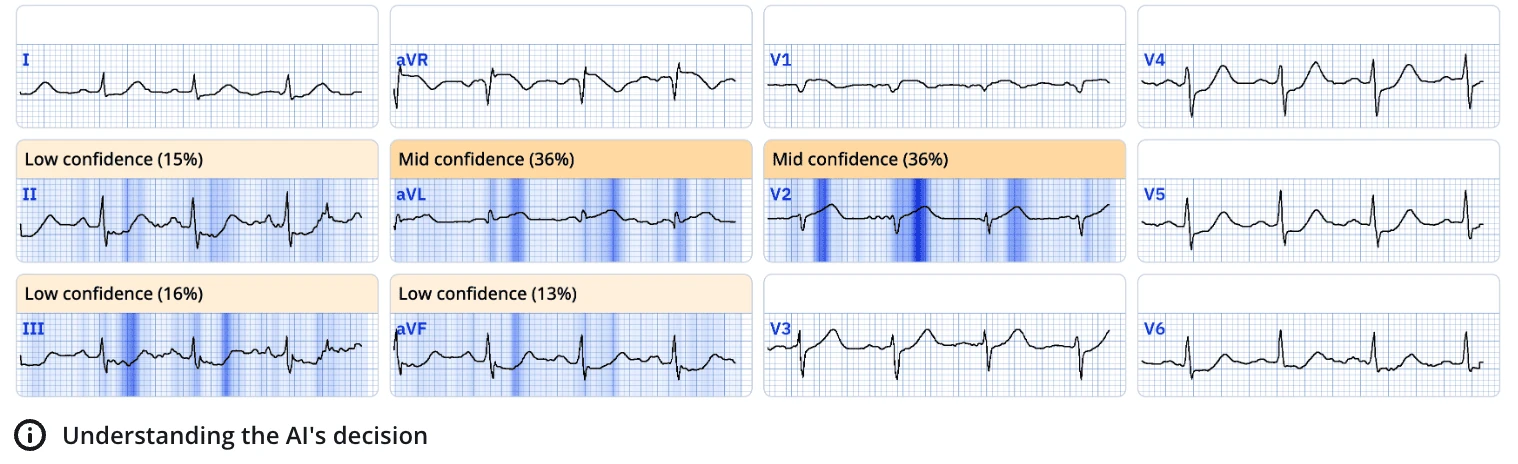 ECGxplain heat map for an ECG diagnostic of acute LAD occlusion with per-lead confidence scores
