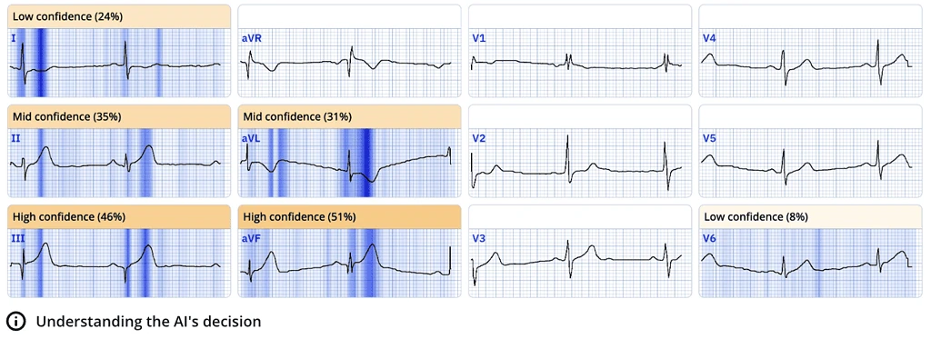 ECGxplain heat map showing enlarged inferior T waves and lateral OMI in V6 with ST elevation below STEMI criteria