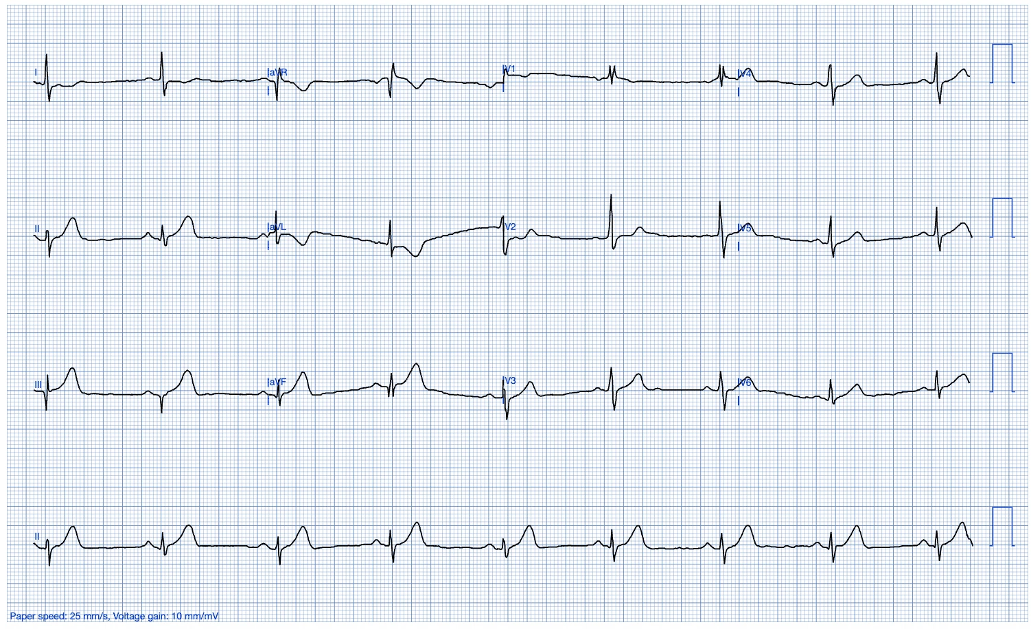 12-lead ECG digitized by PMcardio and flagged as STEMI or STEMI equivalent by the ACS module