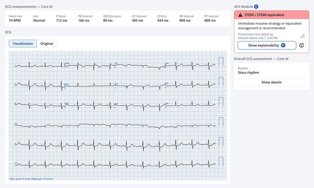 PMcardio desktop report with Core AI ECG measurements flagging STEMI or STEMI equivalent in sinus rhythm
