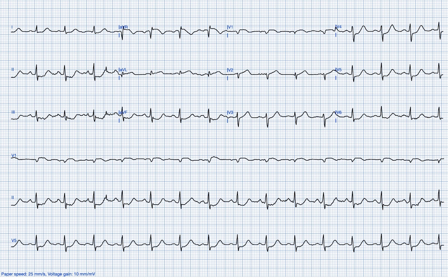 Digitized 12-lead ECG with rhythm strips flagged as STEMI or STEMI equivalent in PMcardio