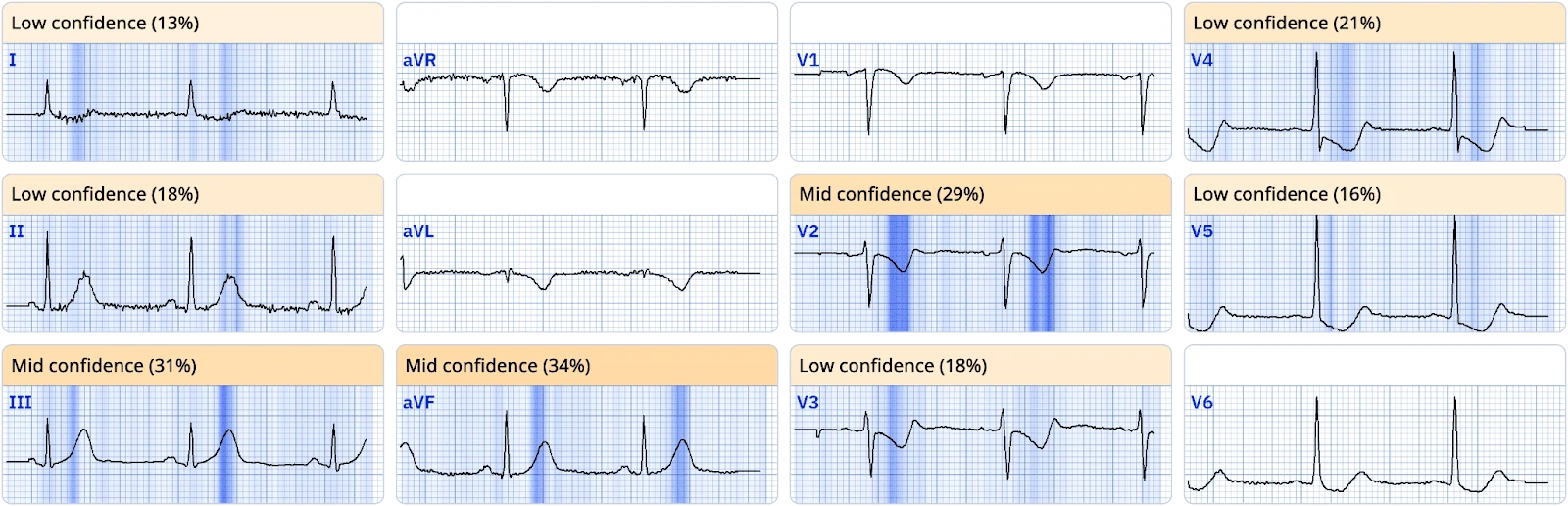 ECGxplain heat map highlighting diagnostically important ECG leads and segments with confidence scores