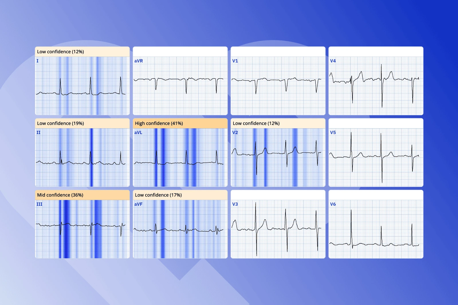 PMcardio ECGxplain heat map over a 12-lead ECG showing per-lead influence scores and confidence badges
