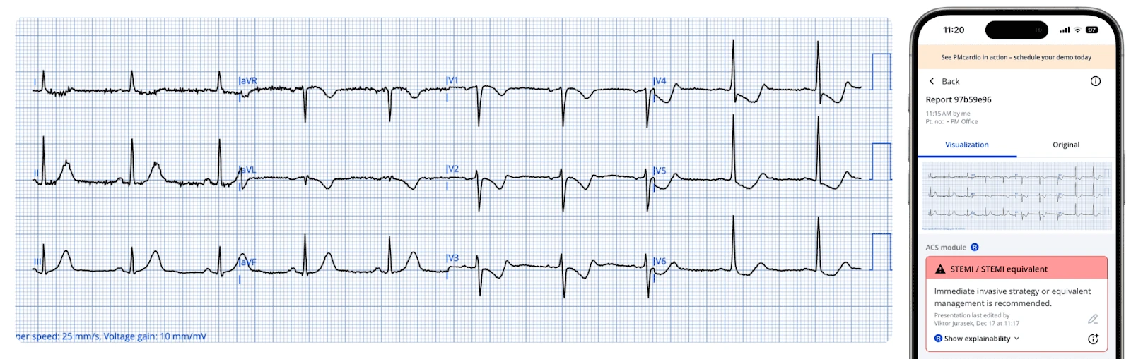 12-lead ECG strip beside a PMcardio phone report flagging STEMI or STEMI equivalent via the ACS module