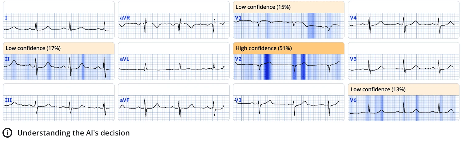 ECGxplain heat map highlighting V2 and V6 segments for an ECG diagnostic of acute LAD occlusion
