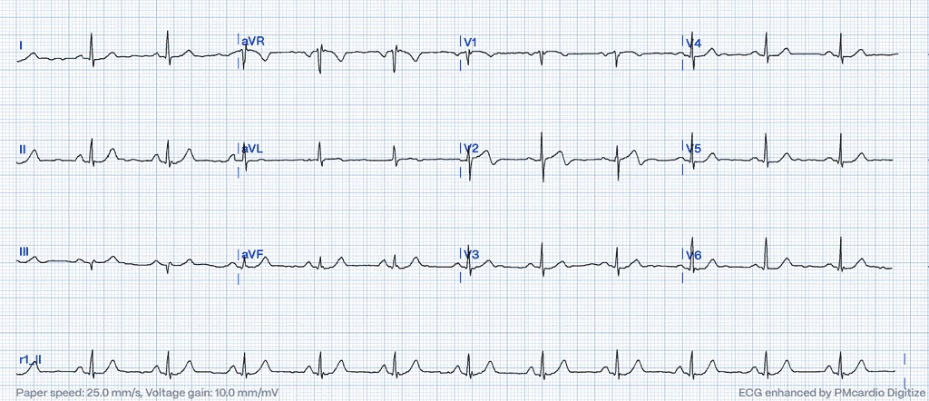 Wellens' syndrome ECG Type A