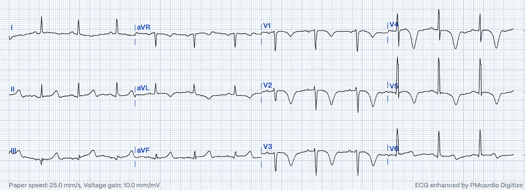 Wellens' Syndrome ECG type B