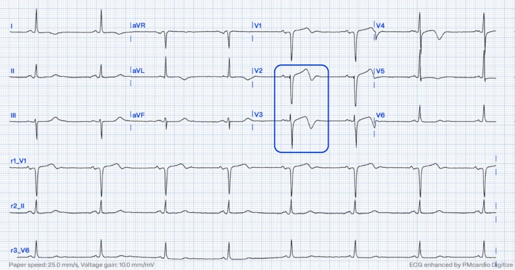 Wellens' syndrome ECG