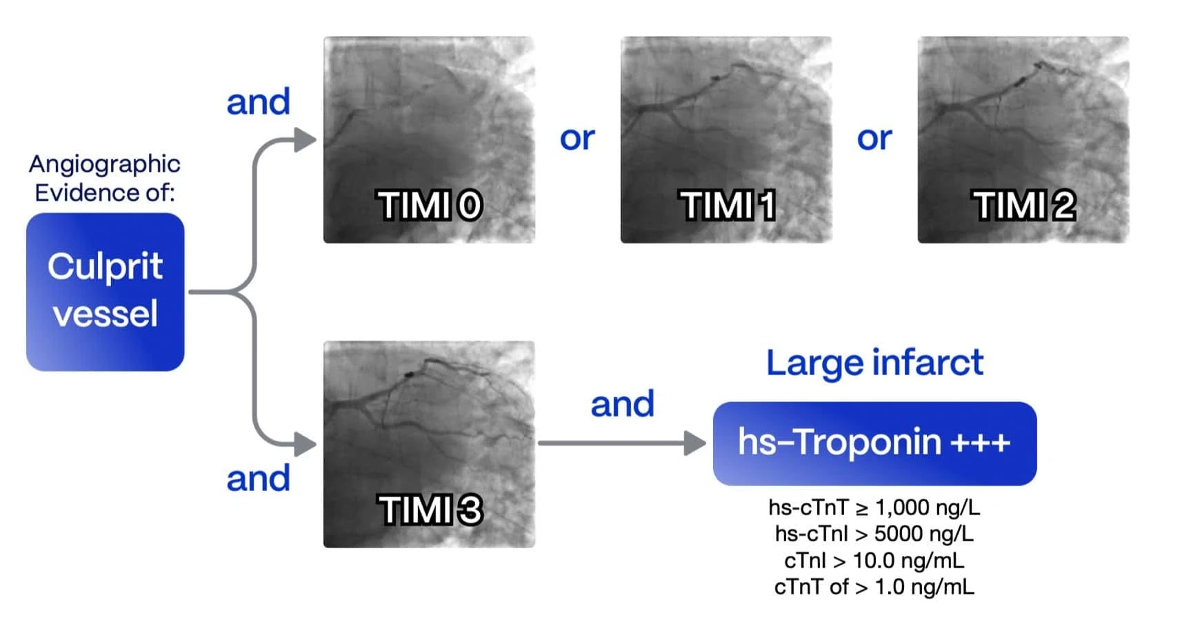 Occlusion Myocardial Infarction (OMI)