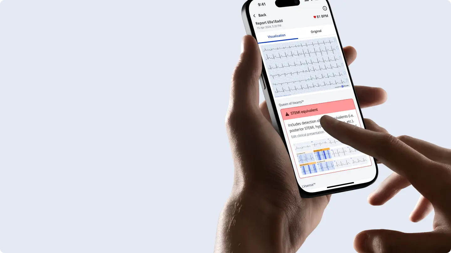 Phone showing PMcardio Queen of Hearts STEMI equivalent result on a captured ECG